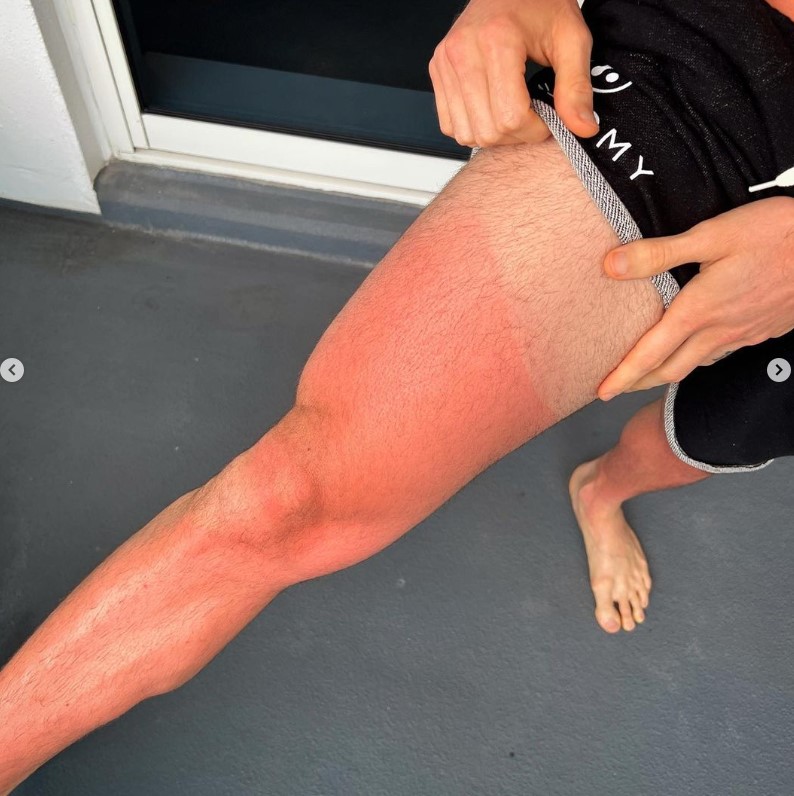 Alok mostrando queimaduras do sol de Miami. (Foto: Reprodução/Instagram)