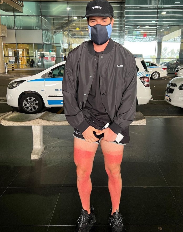 Alok mostrando queimaduras do sol de Miami.