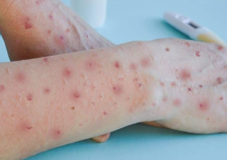 varíola dos macacos