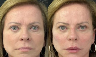 Christina Rocha antes e depois da harmonização