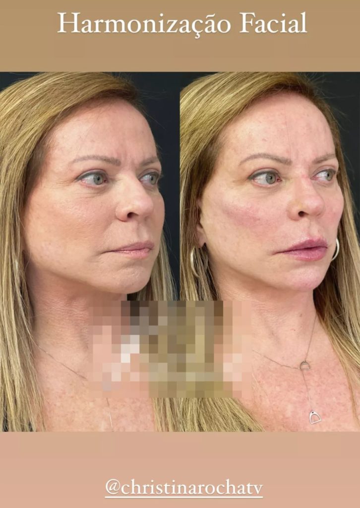 Christina Rocha antes e depois dos procedimentos estéticos