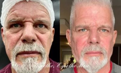 Raul Gazolla antes e depois da harmonização