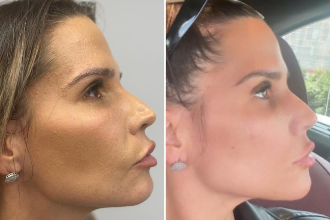 DJ de Jojo Todynho, Taty Zatto, passa por harmonização facial