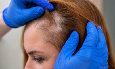 Alopecia: hair stylist Adriano Gonçalves explica sobre a doença que provoca calvície feminina