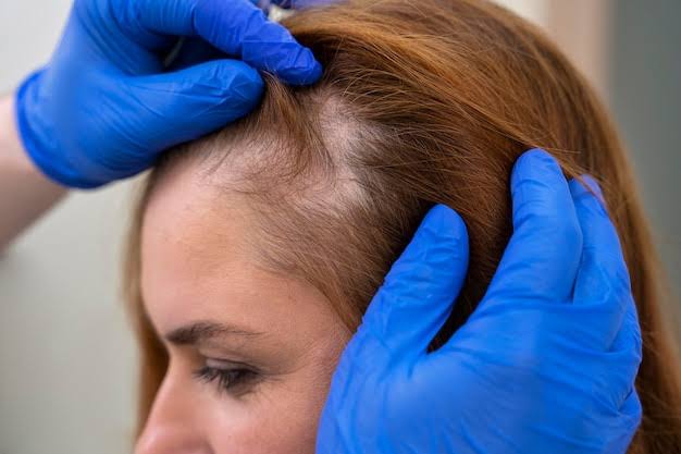 Alopecia: hair stylist Adriano Gonçalves explica sobre a doença que provoca calvície feminina