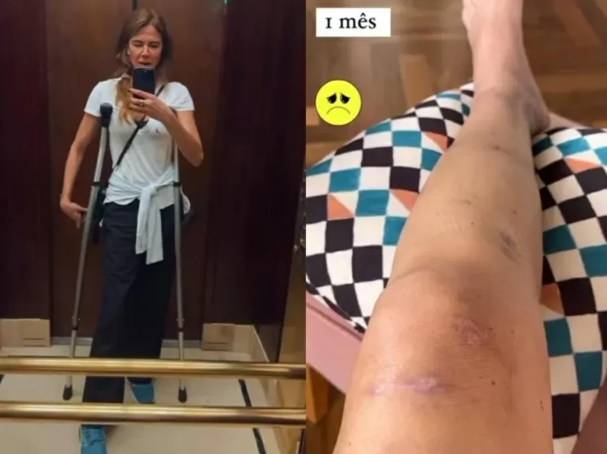 Luciana Gimenez mostra cicatriz da cirurgia na perna