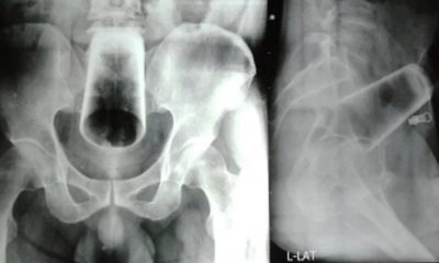 Exame de radiografia mostra copo de vidro no intestino de um homem nepalês