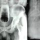 Exame de radiografia mostra copo de vidro no intestino de um homem nepalês