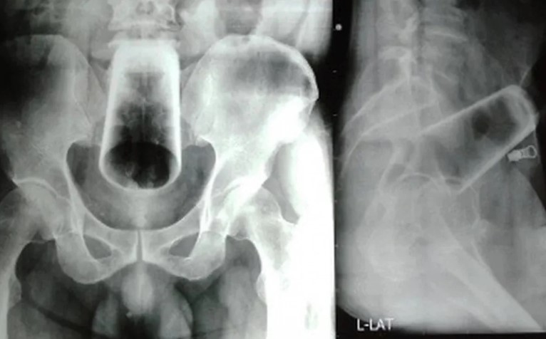 Exame de radiografia mostra copo de vidro no intestino de um homem nepalês