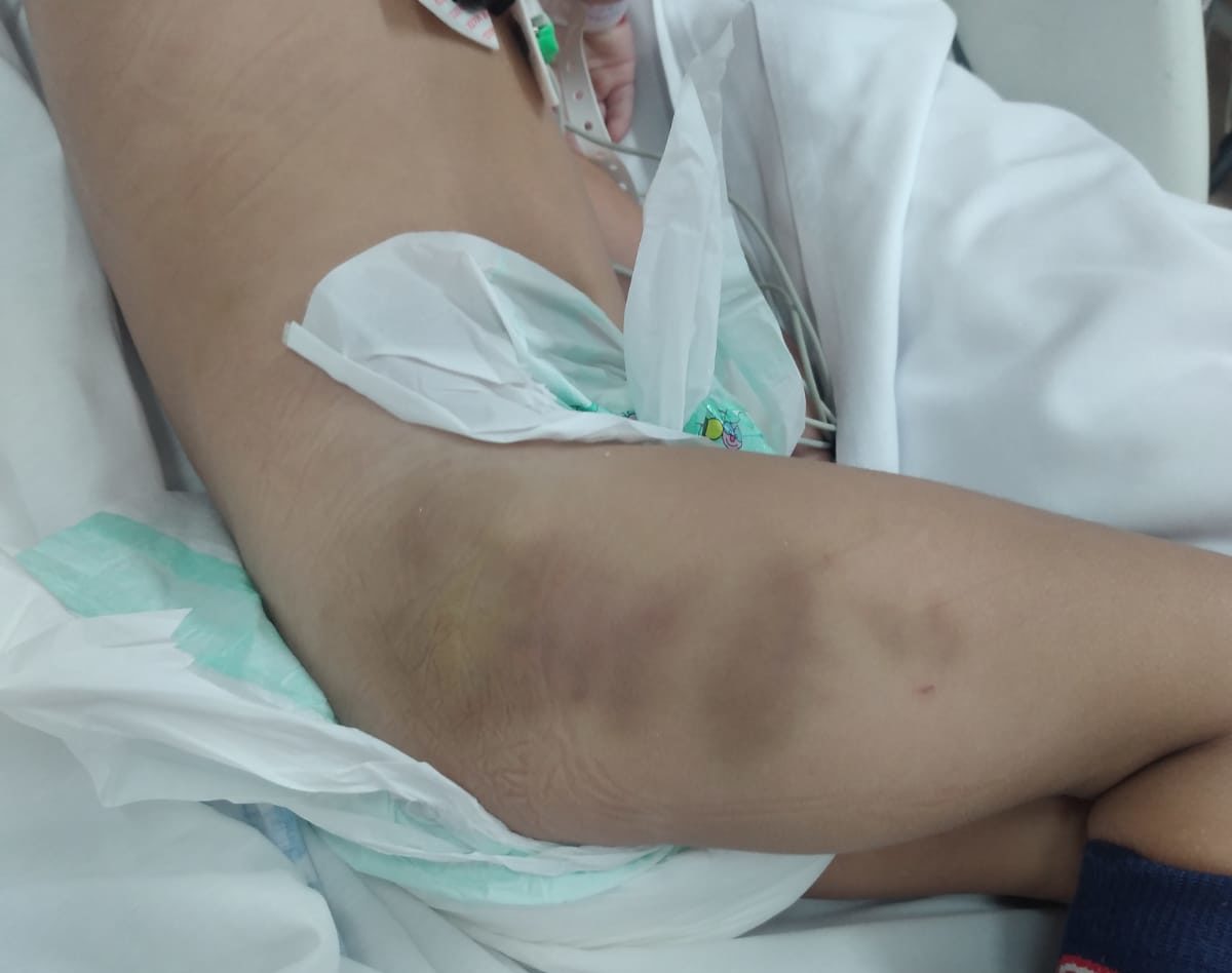 Criança torturada pela madrasta segue internada em estado grave, em São Gonçalo