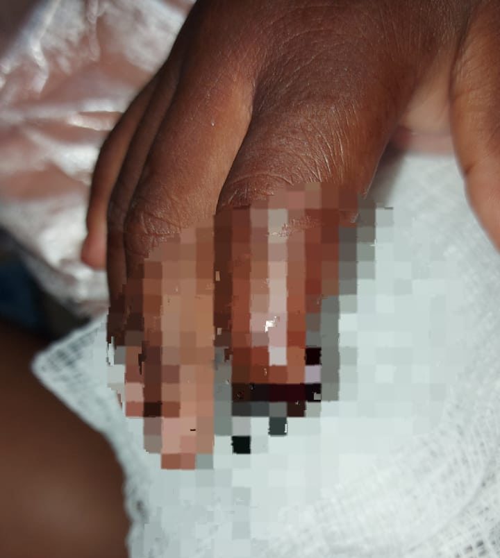 Criança de 3 anos tem dedo decepado em brinquedo na creche