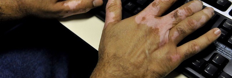 Dia Mundial do Vitiligo alerta para preconceitos contra quem tem a doença (Foto: Governo do Estado do Amapá/ Divulgação)