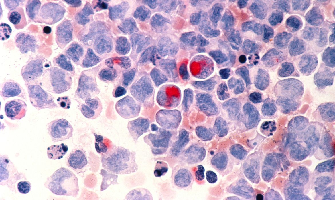 Cansaço por pequenos esforços e fadiga podem ser sintomas de leucemia aguda (Foto: INCA/ Divulgação)