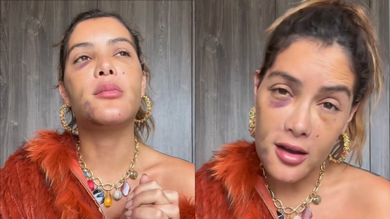 Marcella Maia fala sobre cirurgia para retirada de câncer no rosto