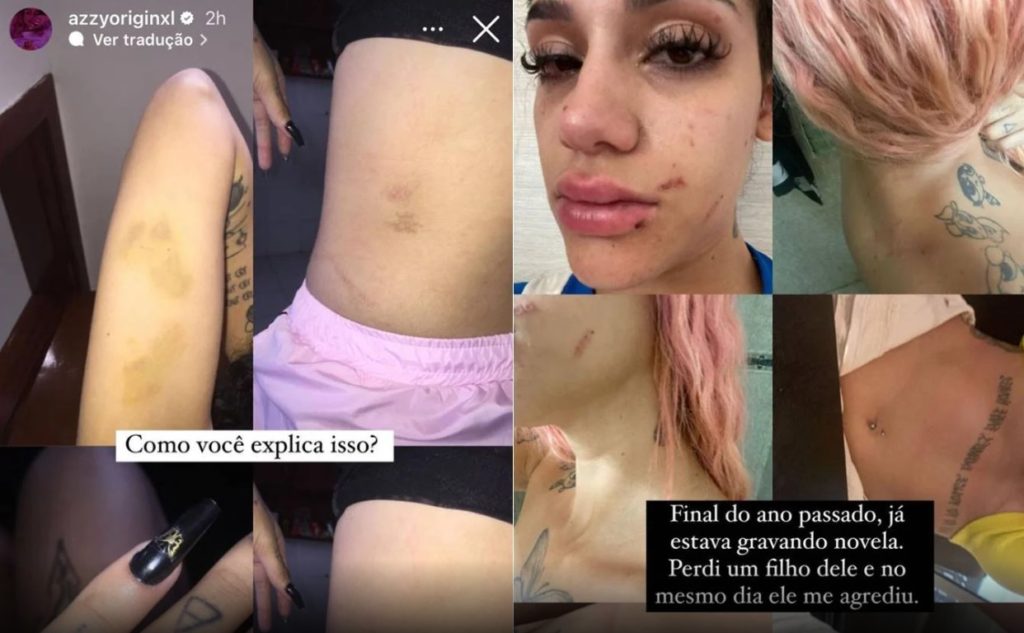Atriz diz ter sido agredida pelo ex e compartilha imagens dos hematomas na internet