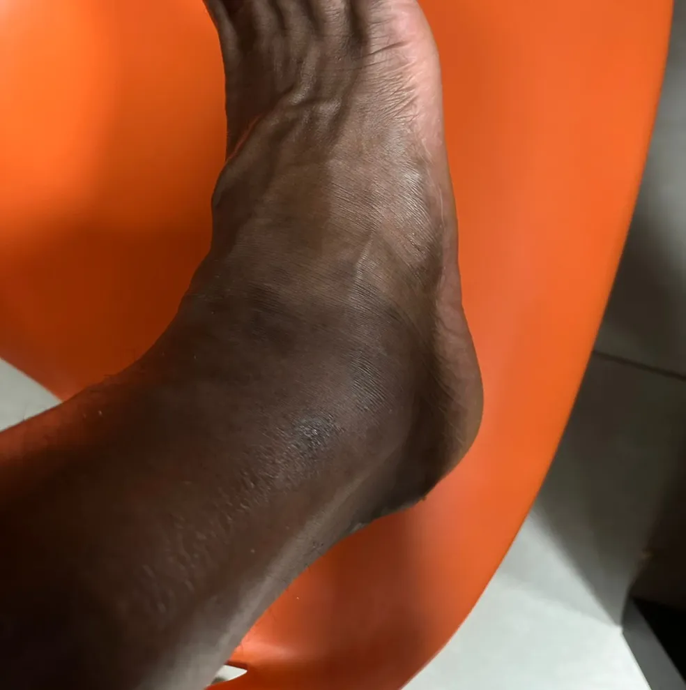 Tornozelo de Léo durante tratamento.