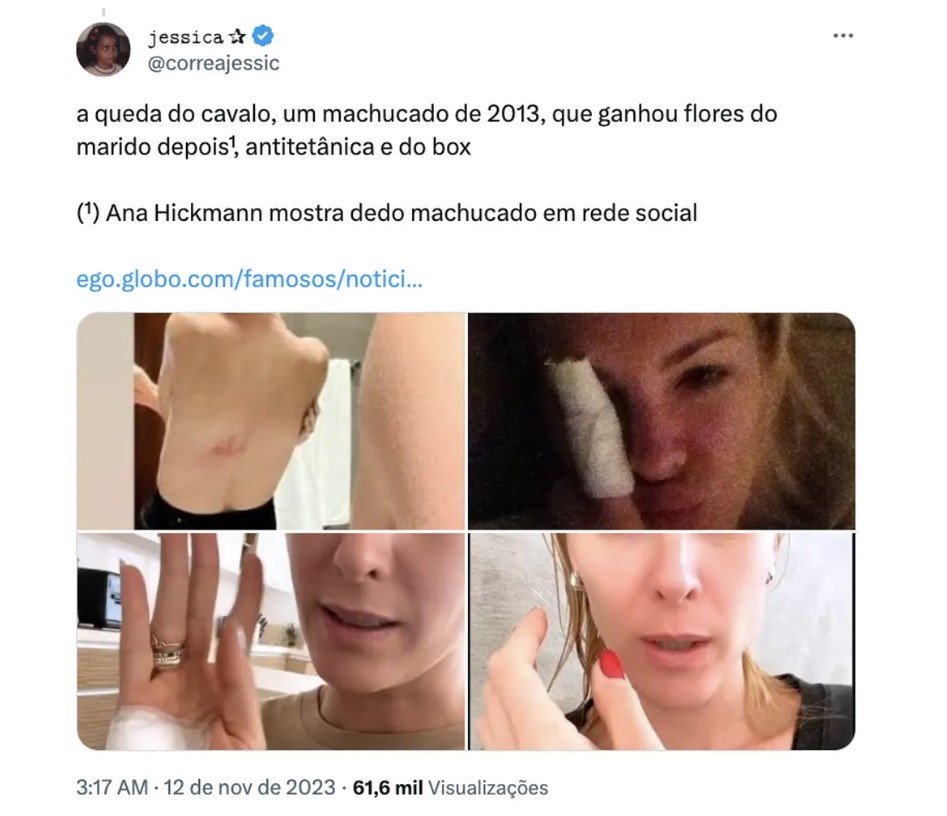 Seguidores de Ana Hickmann relatam sequência de "acidentes domésticos" da apresentadora 