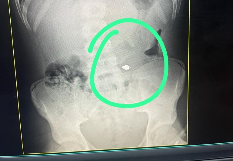 Criminoso é preso após roubar e engolir cordão na praia da Barra