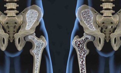 Quedas e osteoporose: entenda a relação e os exames que podem diagnosticar a doença (Foto: Divulgação)