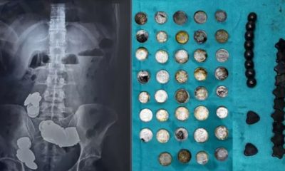 Indiano ingere ímãs e moedas por achar que iria ajudar na musculação