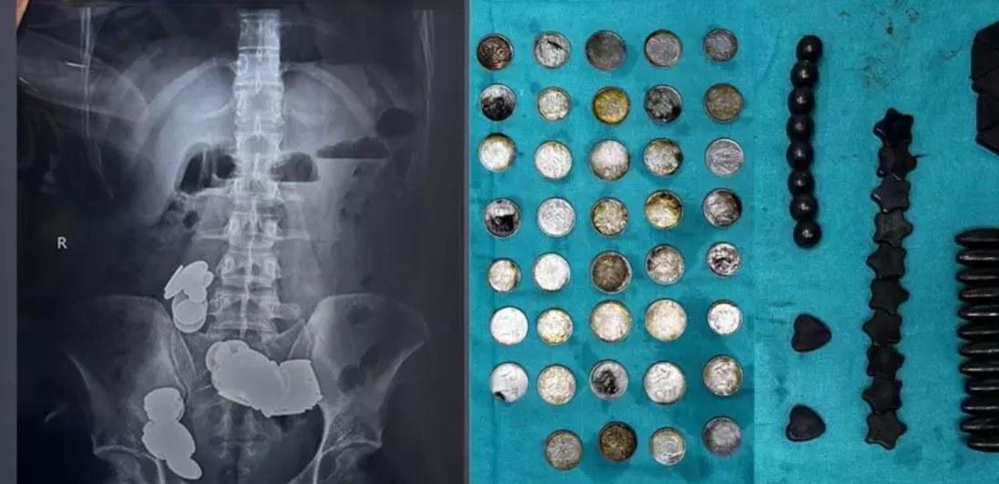 Indiano ingere ímãs e moedas por achar que iria ajudar na musculação