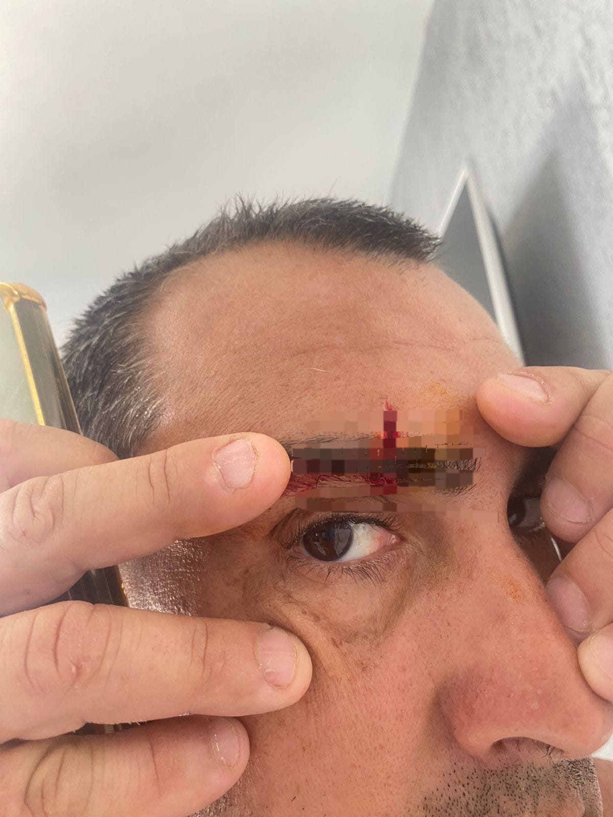 Homem é atacado por pit-bull em Arraial do Cabo