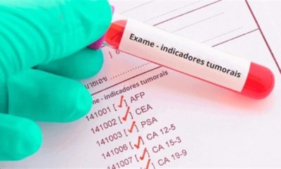 Exame para detectar câncer em pessoas