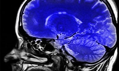 Nutriente vital para o cérebro, colina está presente em vários alimentos; veja os principais