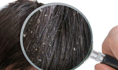 O melhor segredo para acabar com a caspa sem ressecar