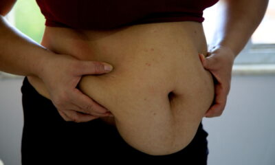 Mitos, verdades, tipos e riscos da cirurgia bariátrica