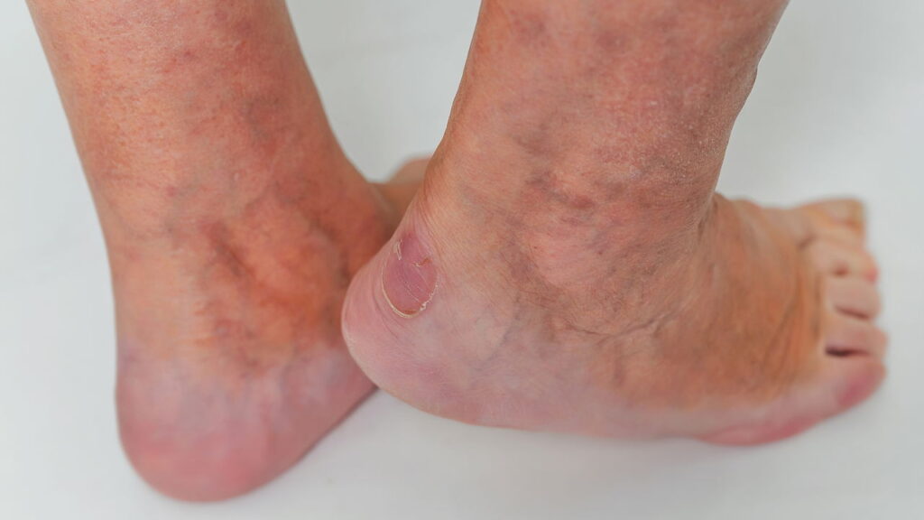 5 sintomas de má circulação que muita gente ignora no Brasil
