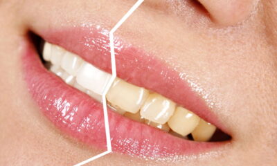 O truque natural para clarear os dentes em casa