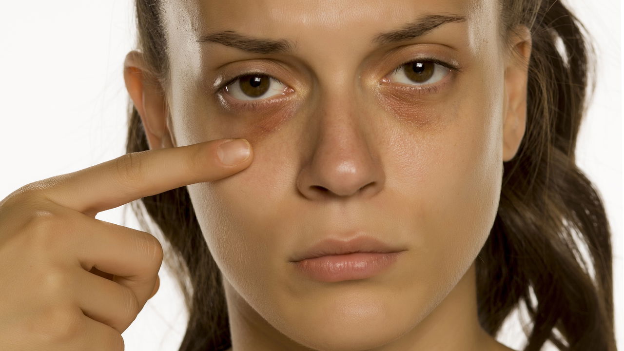 Truque caseiro que acaba com olheiras rapidamente