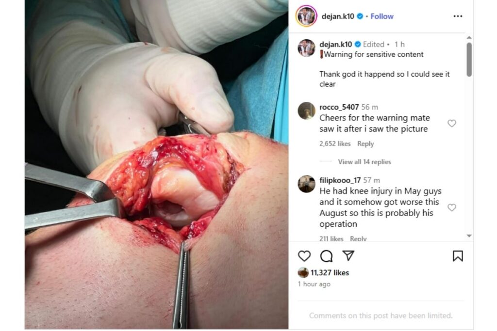 Foto do joelho de Dejan Kulusevski aberto na cirurgia. Foto: Reprodução/Instagram