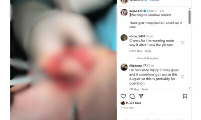 Foto do joelho de Dejan Kulusevski aberto na cirurgia. Foto: Reprodução/Instagram