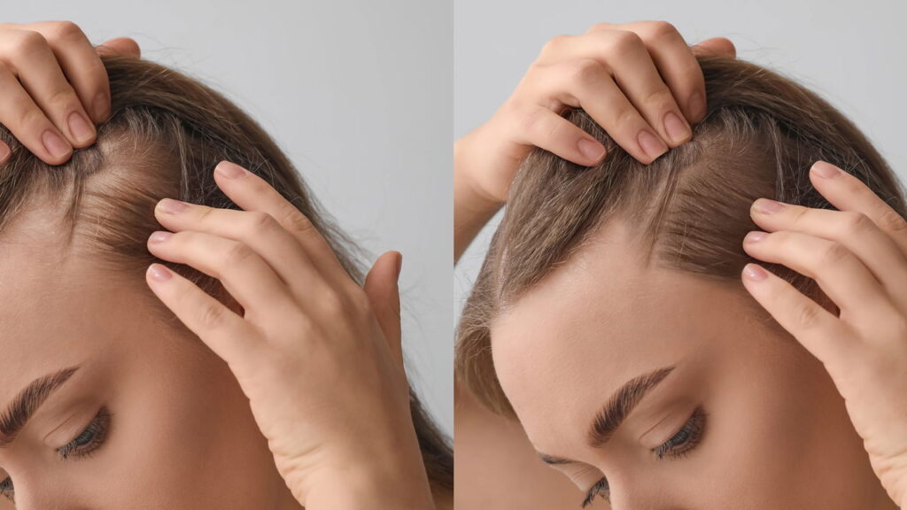 A técnica de inversão vem conquistando espaço entre quem busca acelerar o crescimento capilar de forma natural