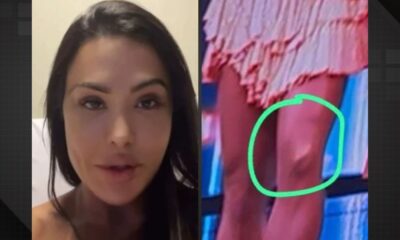 Em cama de hospital, Gracyanne faz desabafo sobre acidente grave