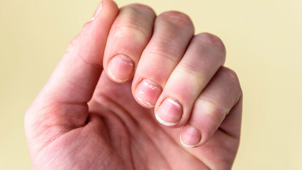 As manchas brancas nas unhas são uma preocupação comum e podem indicar diferentes situações relacionadas à saúde