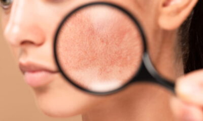 O ingrediente natural que clareia manchas na pele