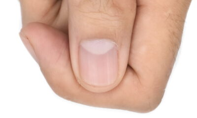 As ondulações inesperadas nas unhas podem causar preocupação e incômodo estético