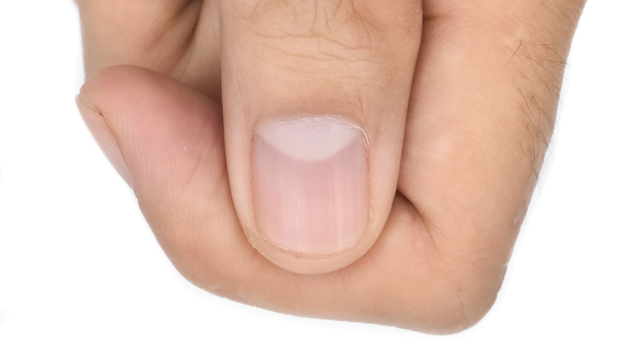 As ondulações inesperadas nas unhas podem causar preocupação e incômodo estético
