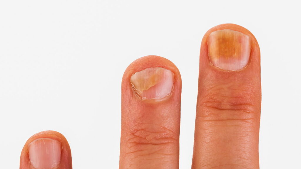 Unhas amareladas podem ser consequência de diversos fatores, variando desde hábitos diários até questões mais sérias relacionadas à saúde