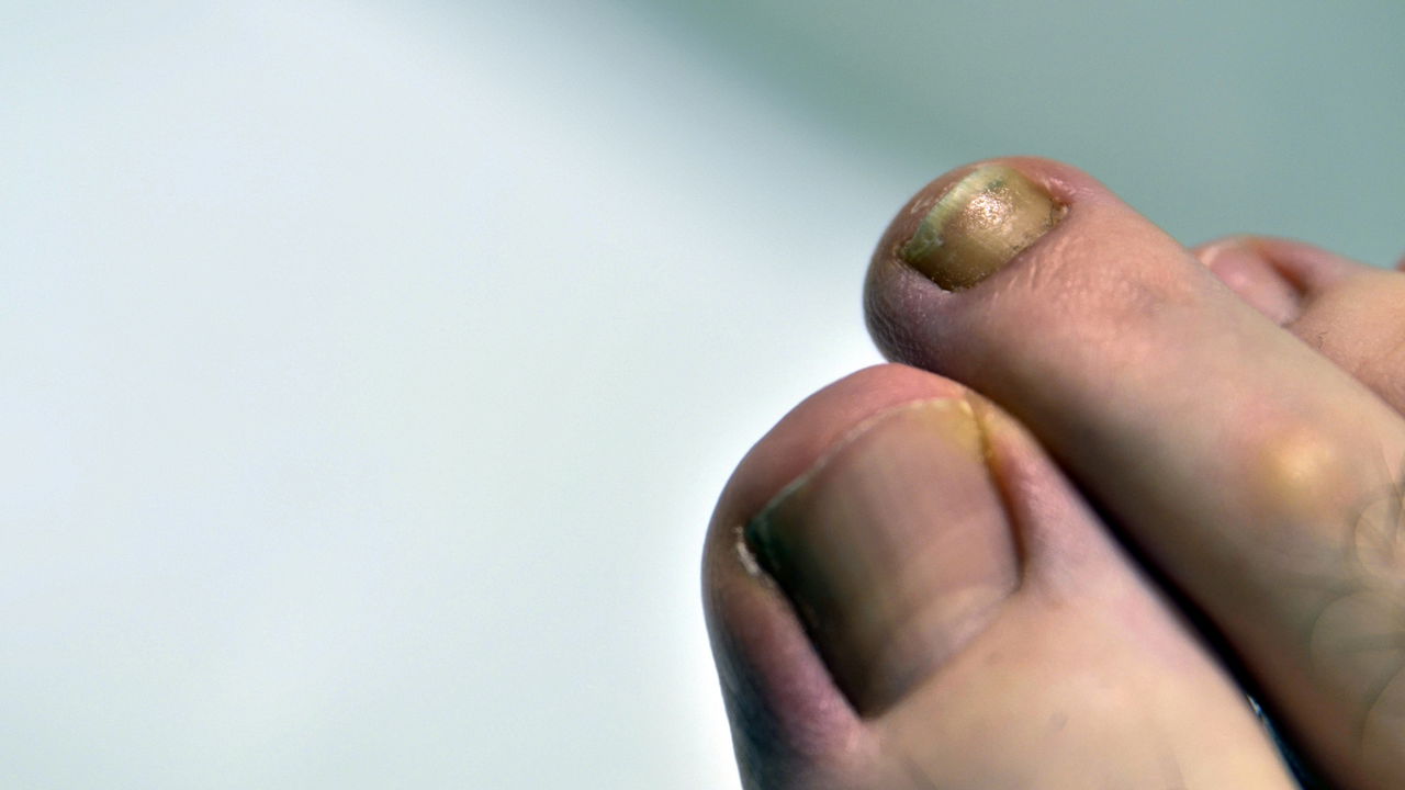 Quando o esmalte nas unhas começa a escurecer, muitas pessoas ficam em dúvida sobre as razões por trás dessa alteração de cor