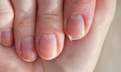 Ter unhas fracas e quebradiças pode ser um importante sinal de alerta sobre o equilíbrio do seu organismo.