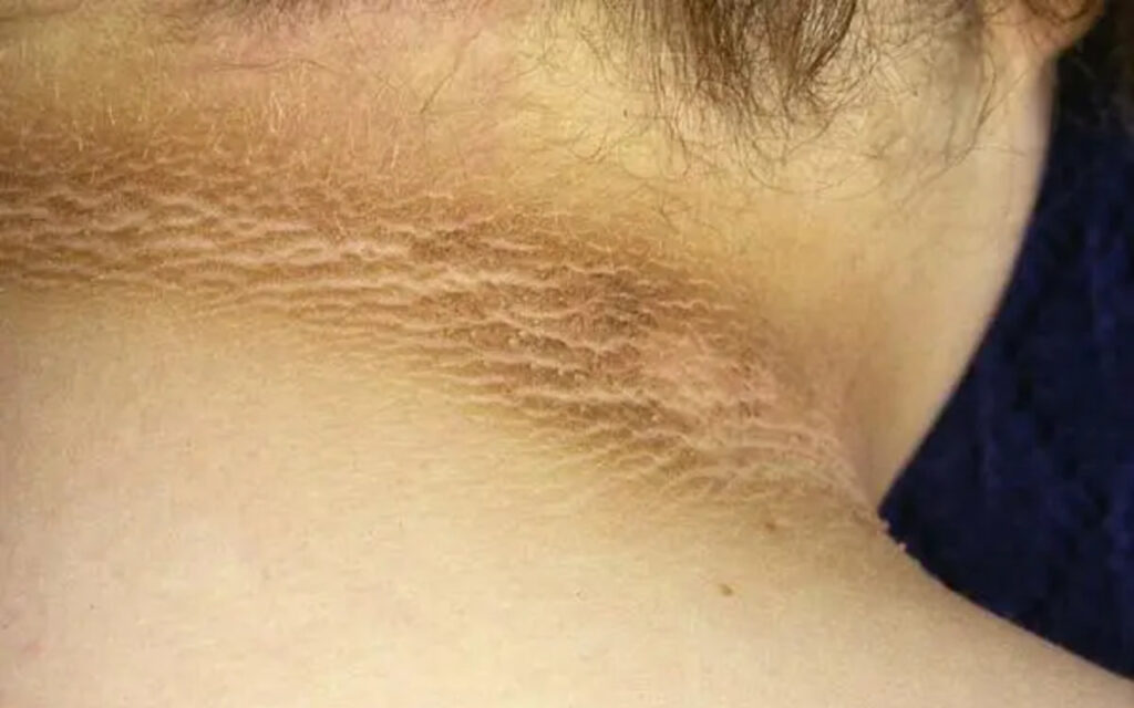 O sinal que aparece na pele e pode indicar açúcar alto no sangue