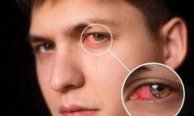 Um sinal discreto no olho pode indicar problemas mais sérios do que parece