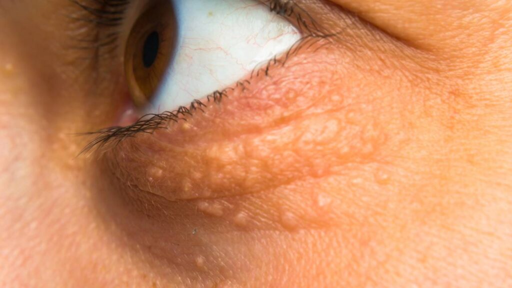 Sinal que o corpo envia quando o colesterol está alto sem você saber