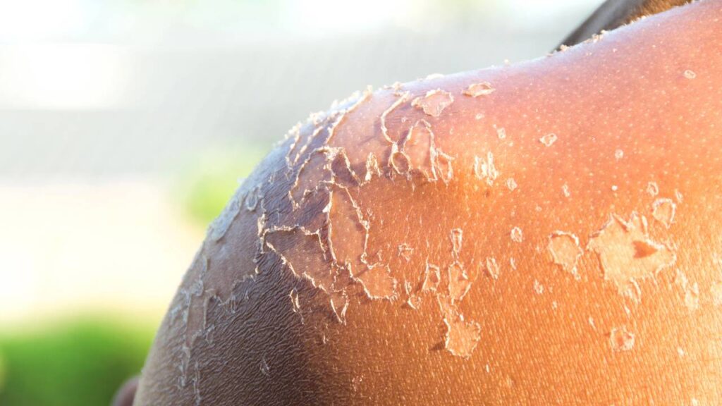 Você sabe qual é o diminutivo de “pele”?