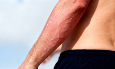 Por que o sol queima mesmo em dias nublados e deixa a pele sensível sem que a gente perceba