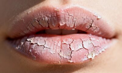 Sinais de desidratação no corpo que você não deve ignorar